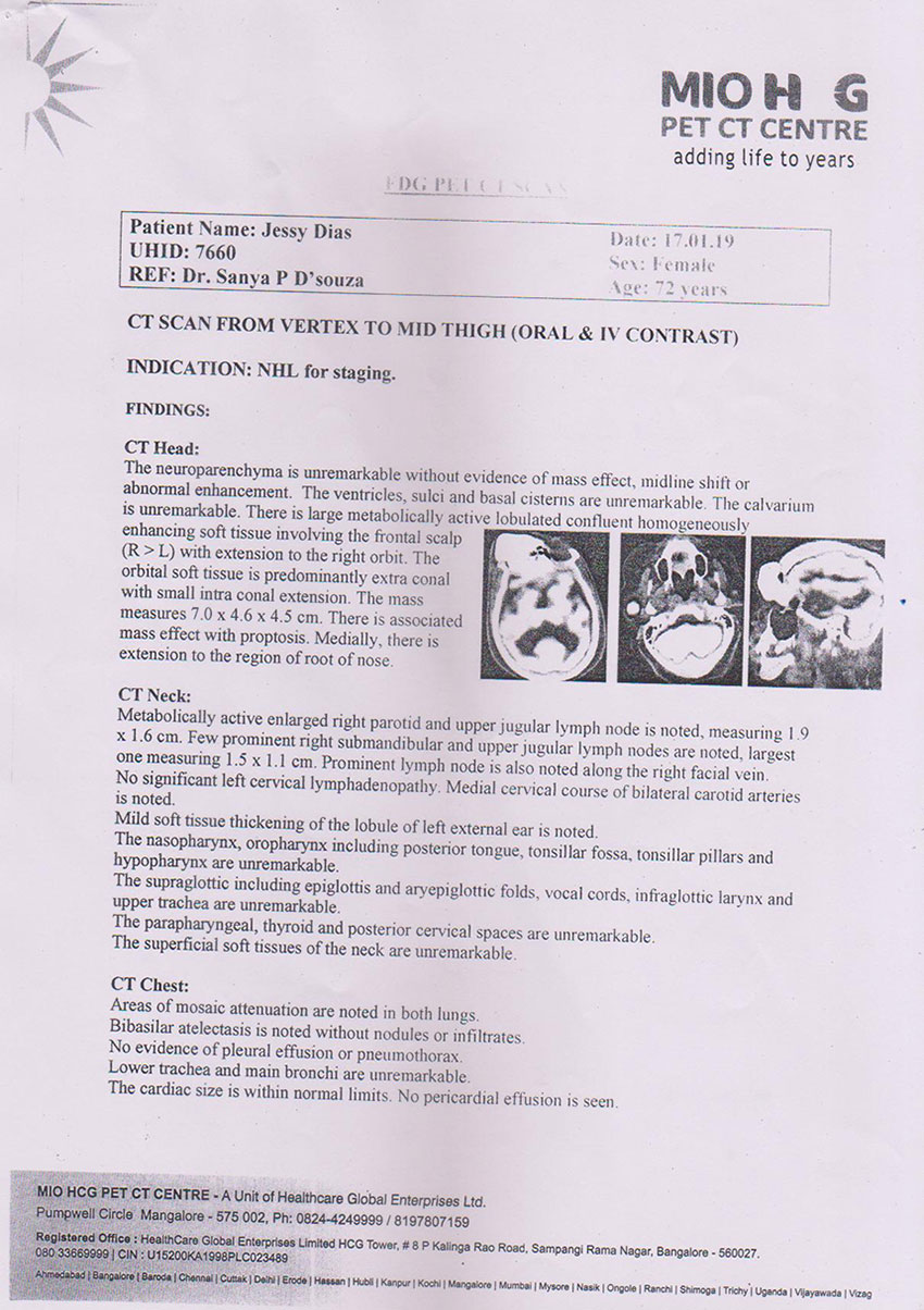 Help Jessy Dais (71) of Mangalore for her Hodgkin Lymphoma Chemotherapy as they are financially inferior. They have requested for monetary help through the Grace Ministry Charity Help Platform. 